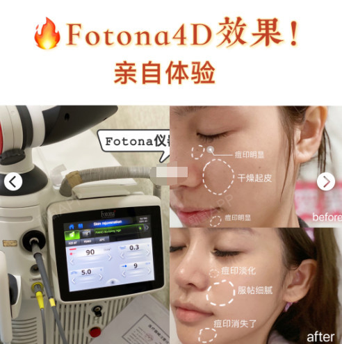 欧洲之星fotona4d面部提升,效果巨好