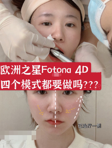 欧洲之星fotona 4d的4种模式,效果真的那么好吗