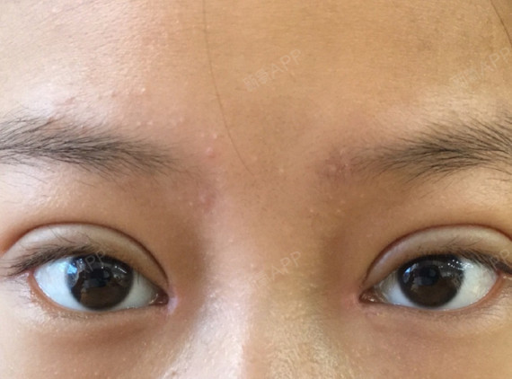 重睑下唇指重睑线至睑缘之间呈厚宽臃肿外观被称之为肉条