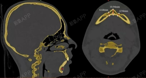 中国研究：下巴注射玻尿酸后骨吸收现象被证实注射下巴玻尿酸怎样维持时间长