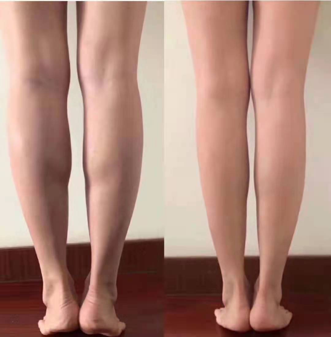 小腿是我怎么减肥都减不瘦的肌肉位置