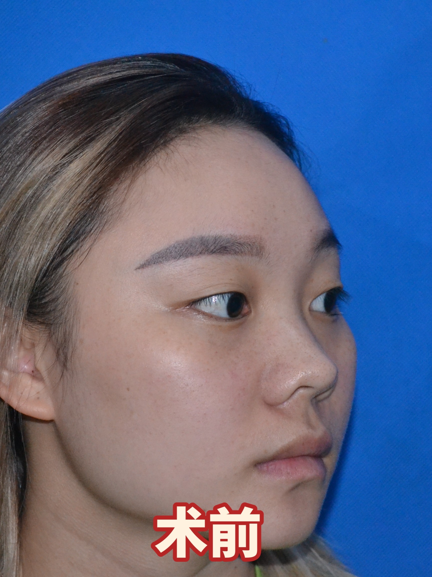 线雕隆鼻后,是否还能做鼻部多项