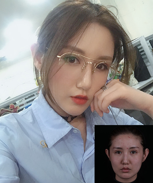 案例分享|玻尿酸填充全脸后的效果