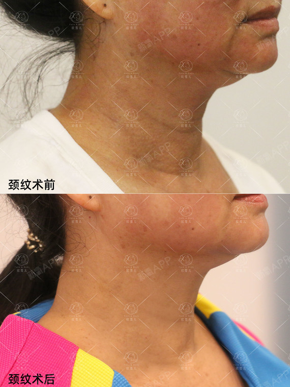 【嗨体祛颈纹案例】