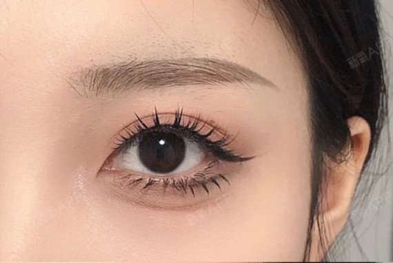 存在2-3种问题,比如常见的有单眼皮,内眦赘皮,肿眼泡,上睑下垂,吊眼