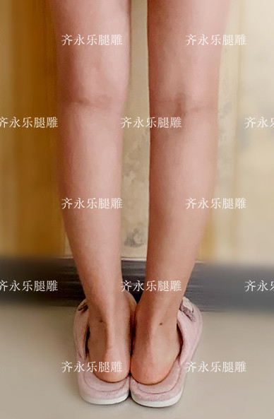 求美者膝内下凹陷,小腿内凹外翻典型的o型腿,这种腿_圈子-新氧美容