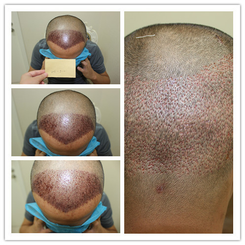 【种植发际线第2天】【大麦微针植发】刚做完的两天头_圈子-新氧美容