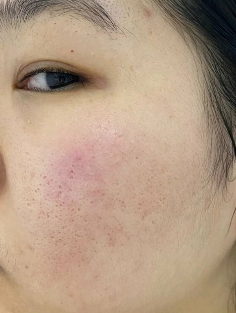 点阵激光到底是非剥脱好还是剥脱好