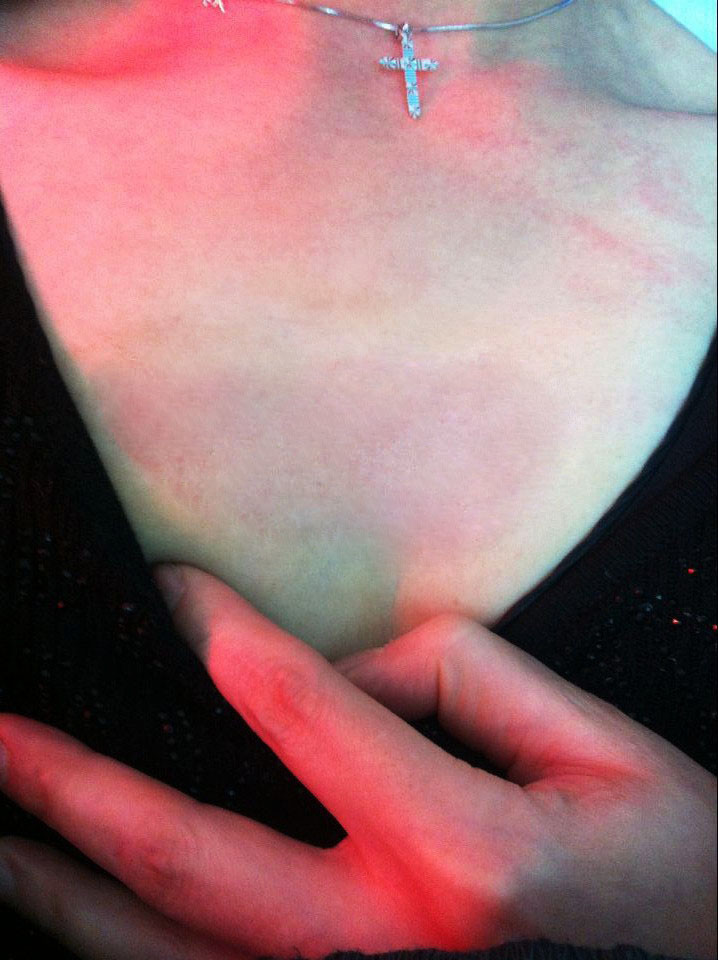 可见胸口明显的疤痕增生疤痕圆润红肿