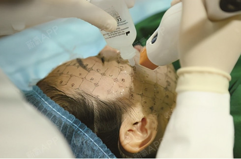 解锁:玛吉操作步骤,热玛吉的原理是什么,值得一看!_圈子-新氧美容整形