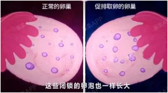 促排的卵子质量好吗卵巢不排卵怎么办