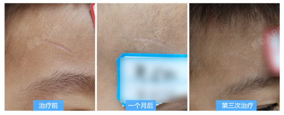 您好,陈旧的白色疤痕是可以通过治疗得以修复改善的,_圈子-新氧美容