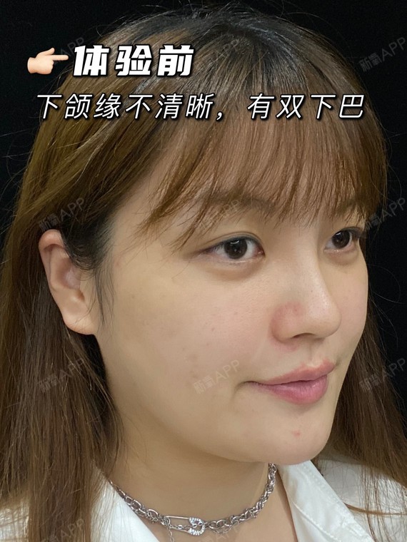 注射整形瘦脸多少钱_注射瘦脸整形_注射整形瘦脸有用吗