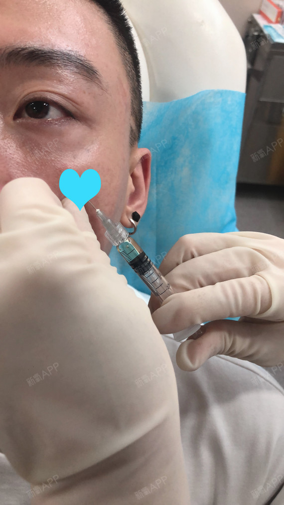 告别泪沟4个月反馈我是5月注射的嗨体泪沟针,我之前_圈子-新氧美容