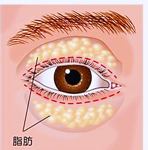 2.肌肉型腫泡眼