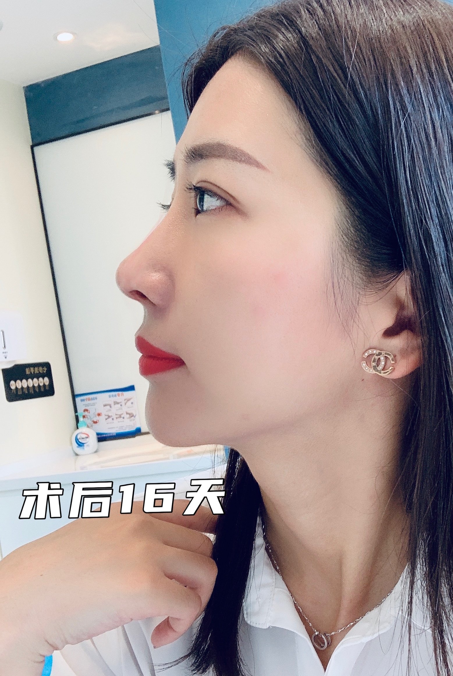 山根低,鼻头不精致 术后效果: 山根高挺,鼻头精致 常见的假体隆鼻材料