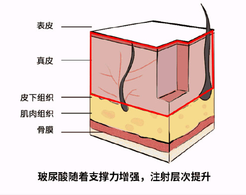 玻尿酸注射层次图片