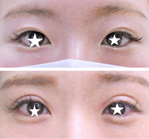 【案例分享】倒反睫毛治疗-双眼皮全切患者年龄:20_圈子-新氧美容整形