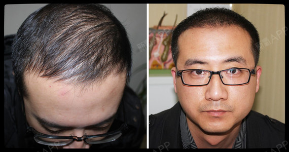 前额脱发,发量日渐稀疏,渐渐显露出头皮,植发2个月_圈子-新氧美容整形