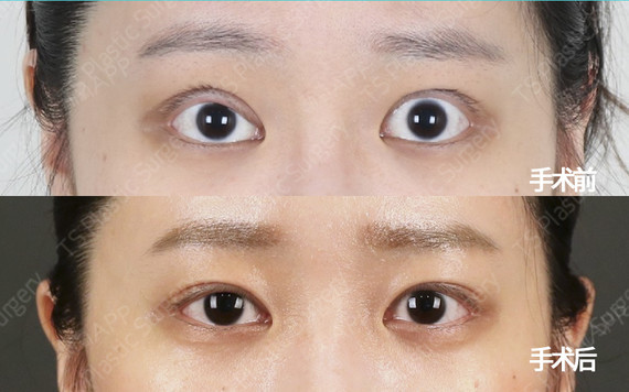 甲亢眼睑退缩手术对比图片