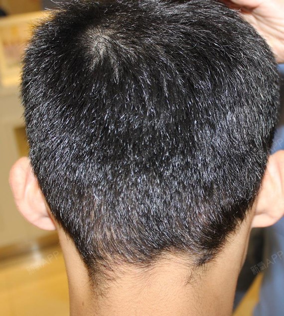 植发许多脱发特别严重到头顶已经没有头发的人,后枕部头发却非常浓密