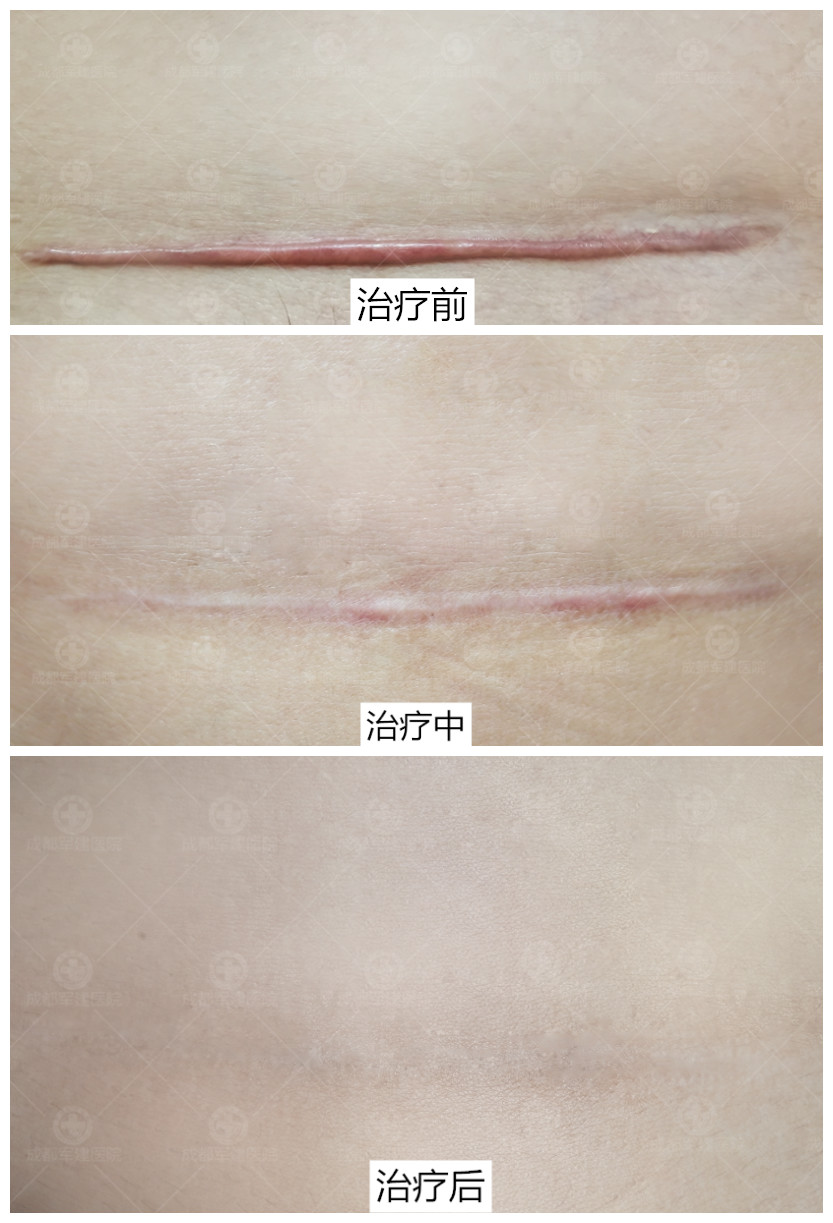 剖腹产疤痕怎么去除