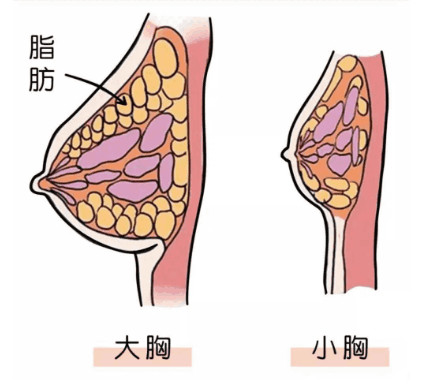 胸部抽脂可以讓胸變小嗎?