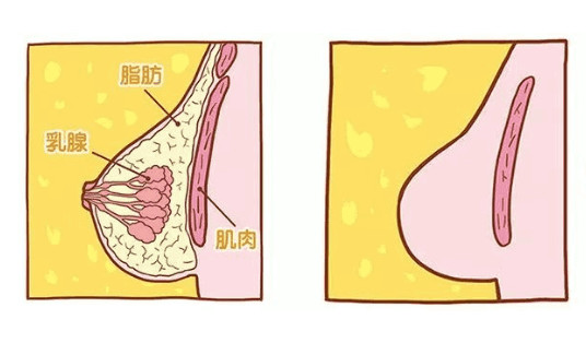 胸部抽脂可以让胸变小吗?