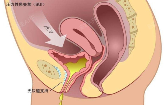 有什麼方法可以解決y道鬆弛問題呢?