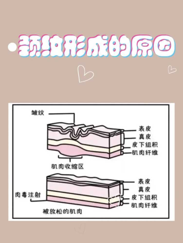 武汉美基元颈纹形成的原因是什么