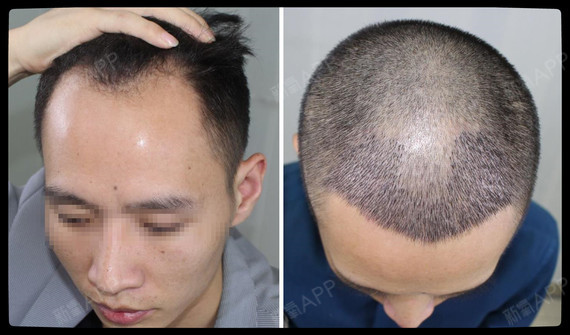 大麦微针植发术后7天,两侧额角种植上的小发茬,看着_圈子-新氧美容