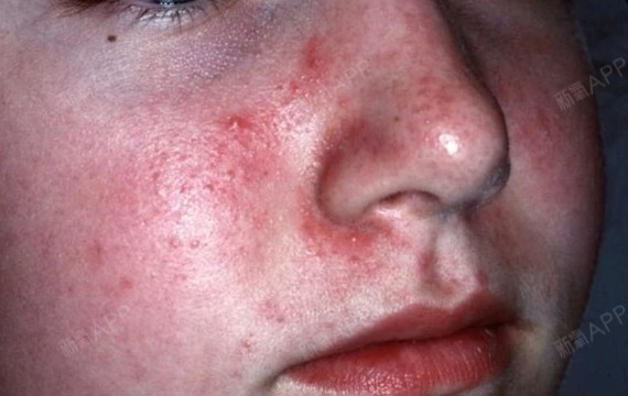 皮肤常年反复潮红,是敏感肌还是玫瑰痤疮?