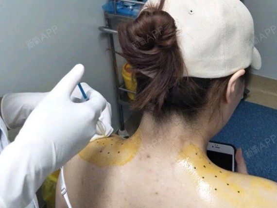 瘦肩针功课丨"虎背熊腰"不用怕,一招还原少女肩背75_圈子-新氧美容