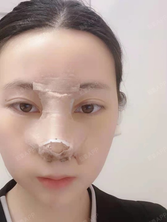 假体取出费用是多少_取出假体需要住院吗_假体取出手术费用