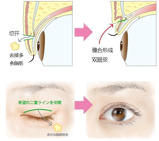 把眼皮的肌肉组织(眼轮匝肌,提上睑肌,睑板,眼窝隔膜等)组合缝合形成