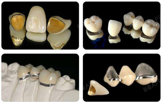 牙冠有哪些種類?_新氧-專業醫美服務平臺