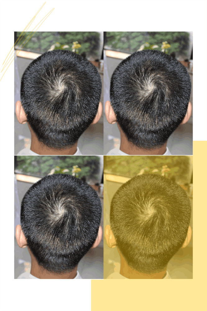 不仅发际线的形状好看了许多,头顶也好_圈子-新氧美容整形