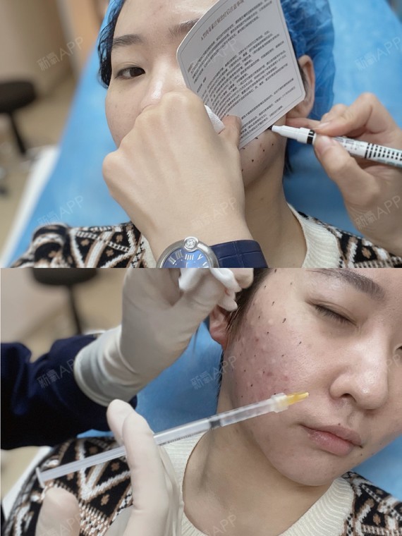 [:63]油痘肌终极法宝——肉毒素微滴注射实测注射_圈子-新氧美容整形
