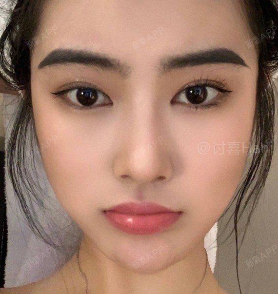 分享一组自然型的双眼皮模板,给准备做眼睛功课的集美_圈子-新氧美容