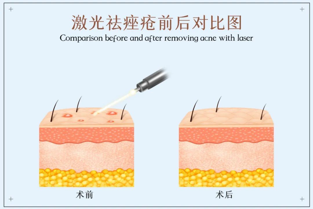 做激光美容，请小心这些陷阱！