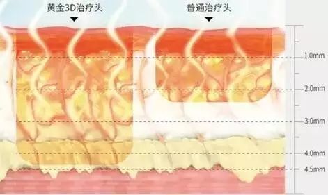 抗衰仪器——超声炮、热拉提、热玛吉都有哪些功效和区别？