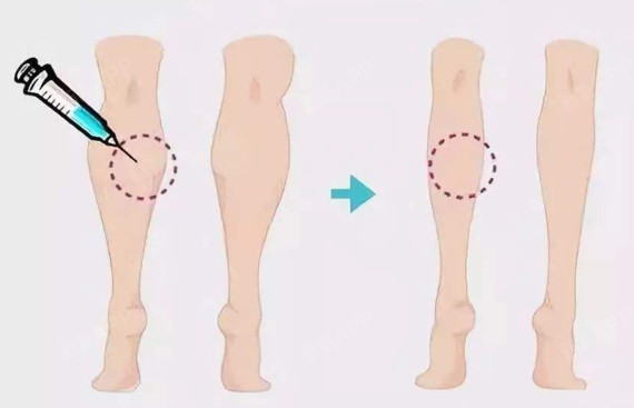 小腿吸脂or注射瘦腿会影响小腿功能吗?小腿粗,有脂_圈子-新氧美容整形