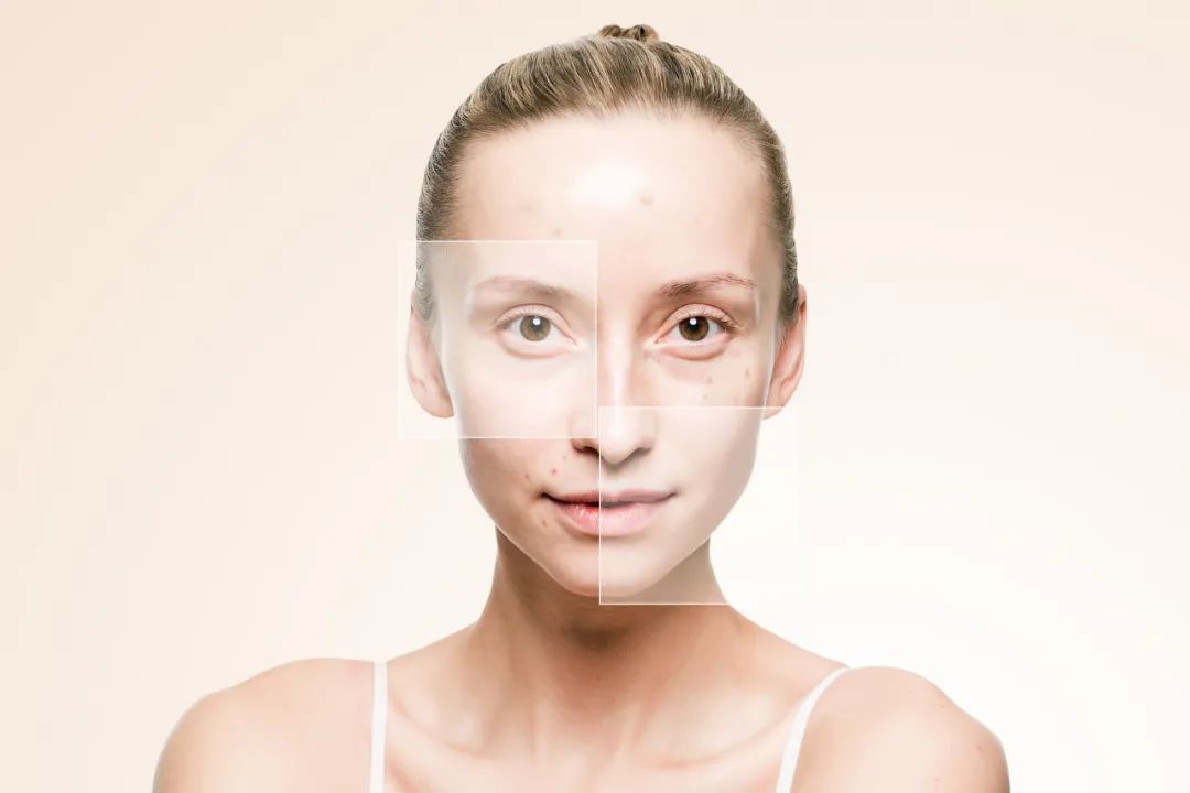 果酸治疗、光子嫩肤、点阵激光等7种常见皮肤医美项目介绍