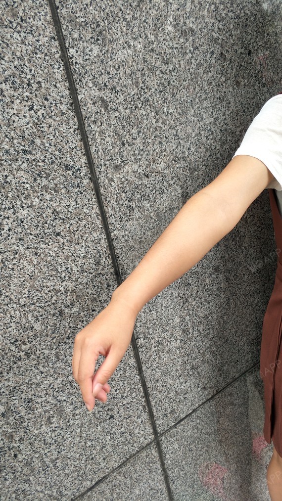 20天了,好快啊,效果越来越让我惊喜,手臂细了很多_圈子-新氧美容整形