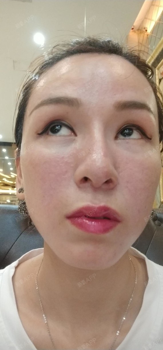 玻尿酸丰泪沟好不好_效果图_素好女孩玻尿酸丰泪沟术后第0天_新氧美容