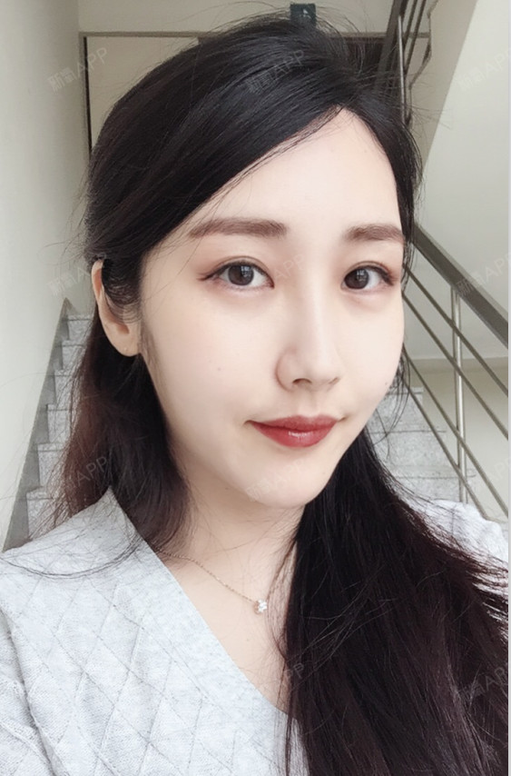 小昵宝下巴截骨术第62天美丽日记