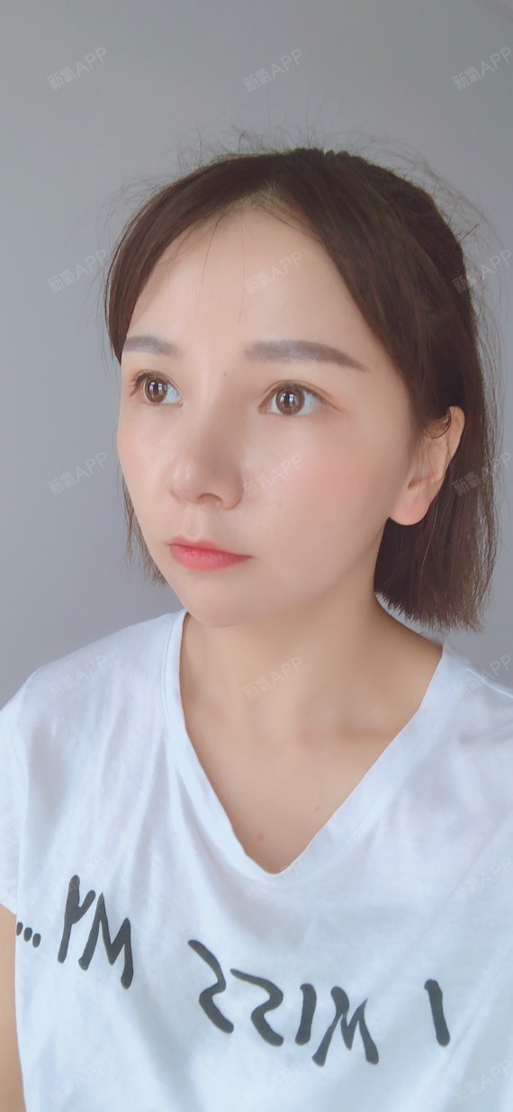 杭州艺星鼻综合术后13天】时间过得很快吧,鼻子恢_圈子-新氧美容整形