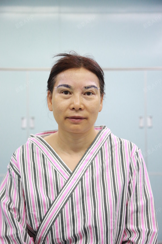 北京切眉术好不好_效果图_女神刘涛姐姐切眉术术后第1天_新氧美容整形