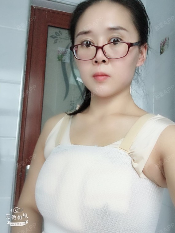 术后七天啦,还木有拆线呢,因为有做胸部提升术所以