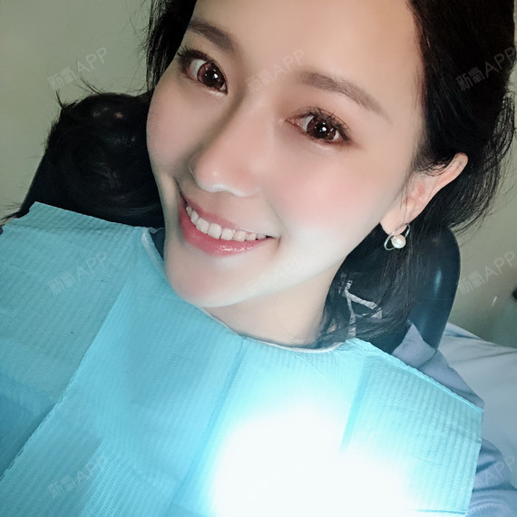 成都耳软骨复合隆鼻好不好_效果图_芒果蜜桃葡萄紫耳软骨复合隆鼻术后